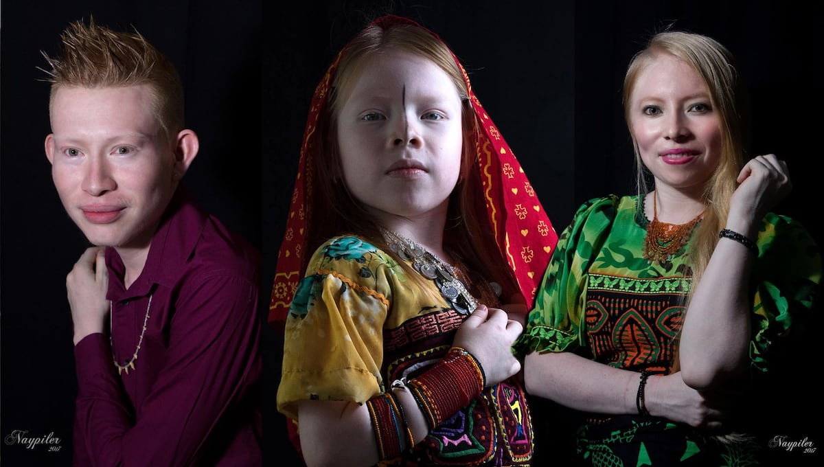 Aprende más sobre los albinos este 13 de junio