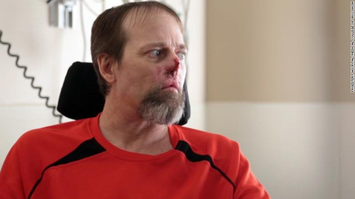 Este hombre quedó mutilado por una bacteria que contrajo de su perro