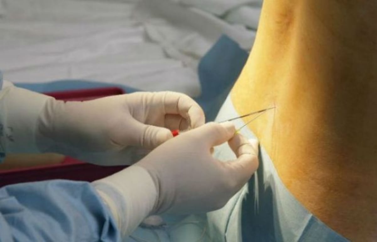 Una aguja epidural estuvo alojada en la espina dorsal de una mujer 14 años
