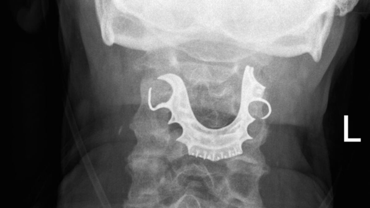Hombre pasó una semana con la dentadura postiza en su garganta