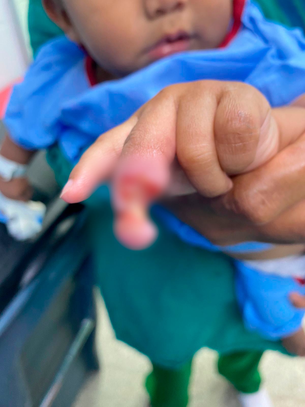 Quemaduras en niños siguen en aumento: Líquidos calientes y pirotecnia, las principales causas