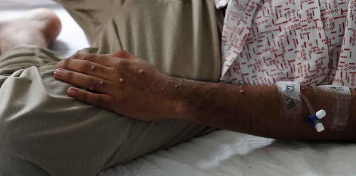 Minsa confirma 27 nuevos casos de viruela del mono