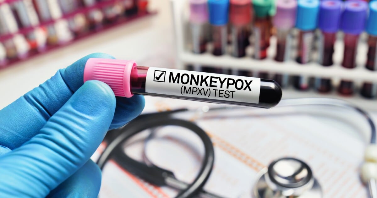 Se confirman dos nuevos casos de viruela símica en el país