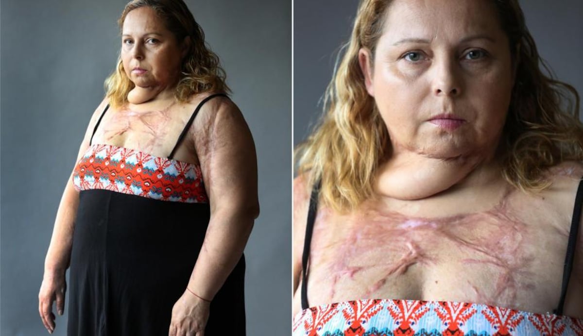 La mujer que pasó por más de 50 operaciones tras brutal intento de feminicidio