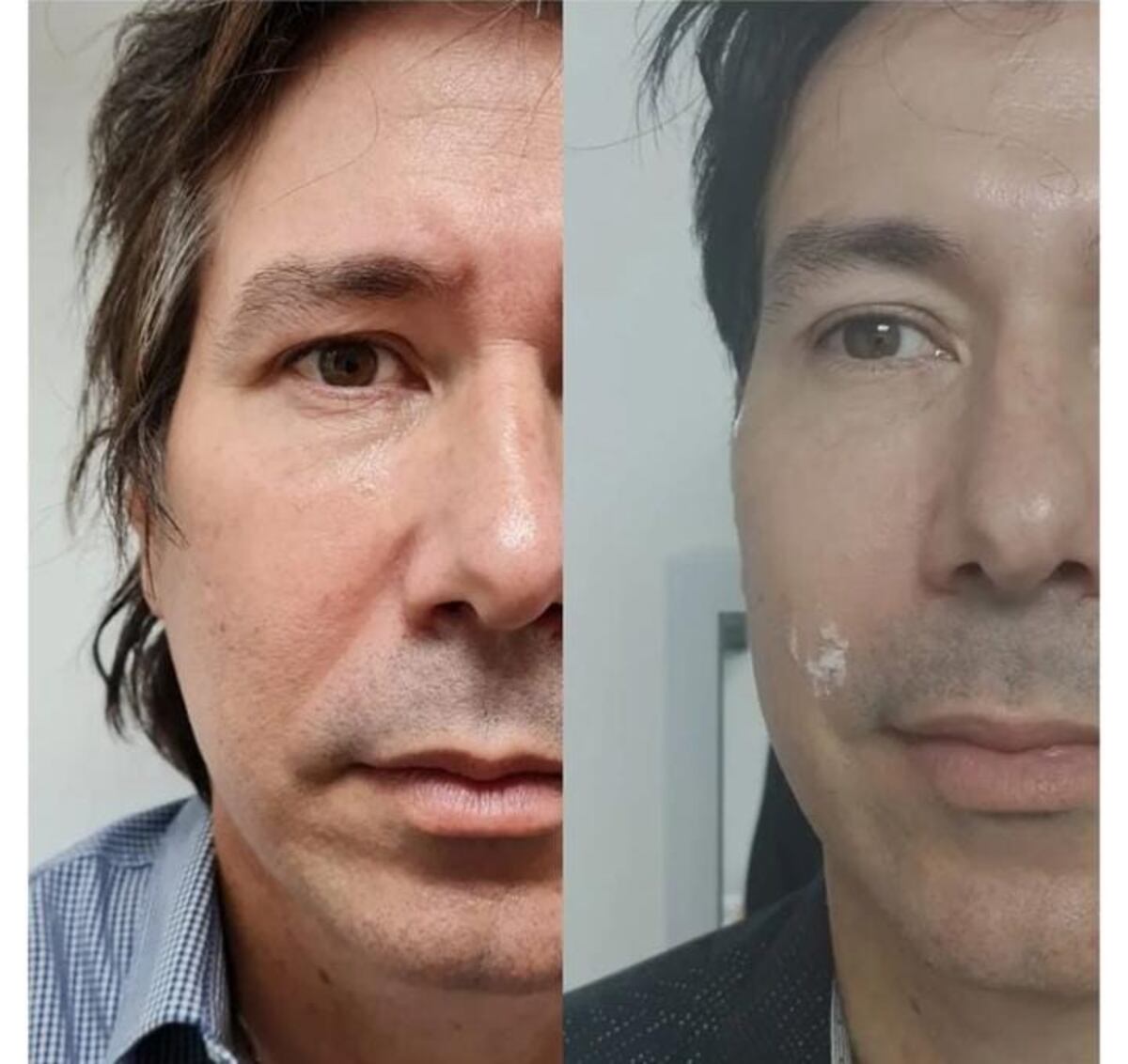 Emilio de Los Rabanes se alisa el rostro con bótox