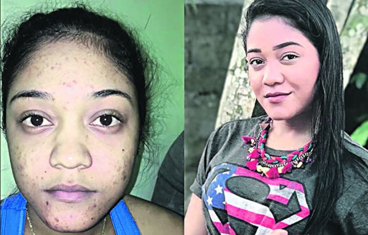 ¡SUFRIÓ DE ACNÉ! La ex Canta Conmigo 'Anarkelys' no se avergüenza 