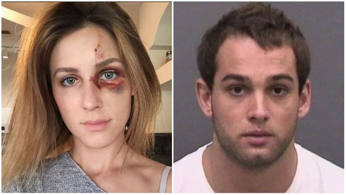 Novia acusa a campeón de motrocross de darle una brutal golpiza por celos