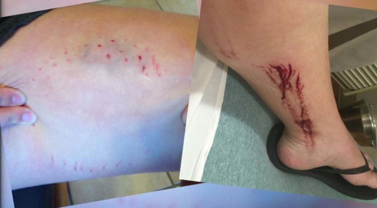 En hecho inédito 2 jóvenes fueron atacados por tiburones en playas de Nueva York