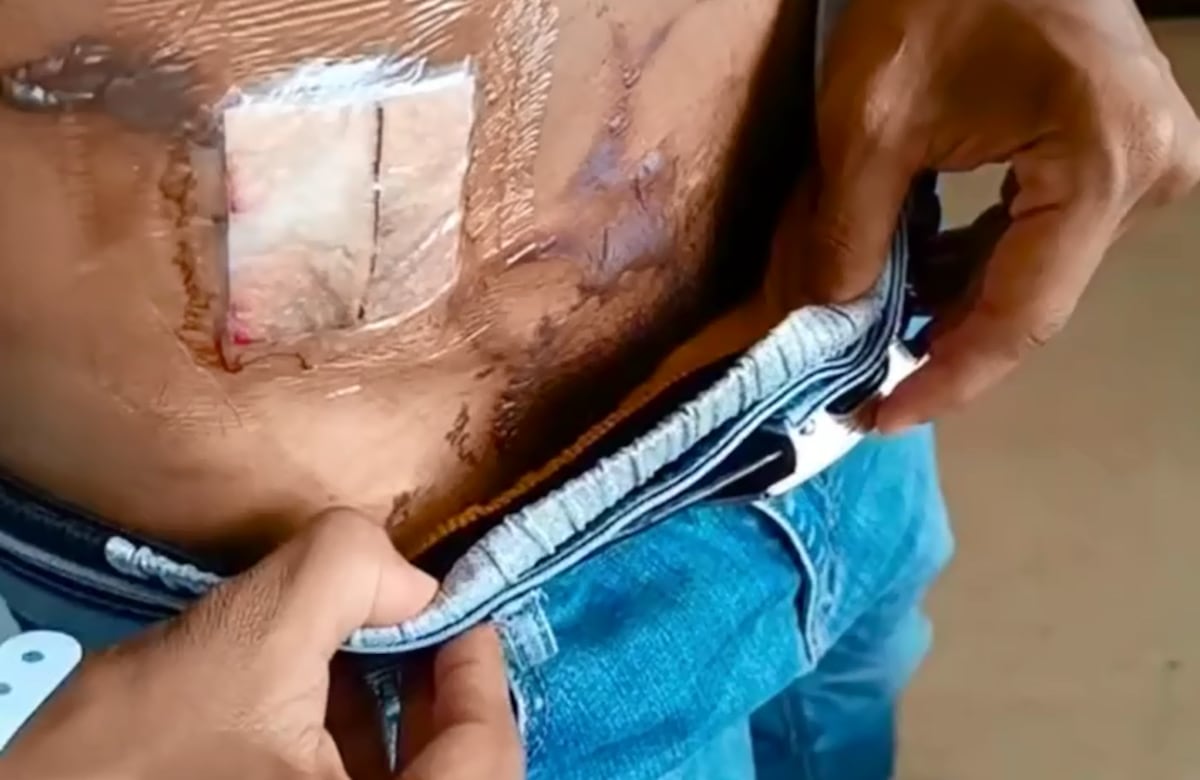 Escándalo en el quirófano: menor terminó quemado en hospital Nicolás Solano. Suspenden al médico