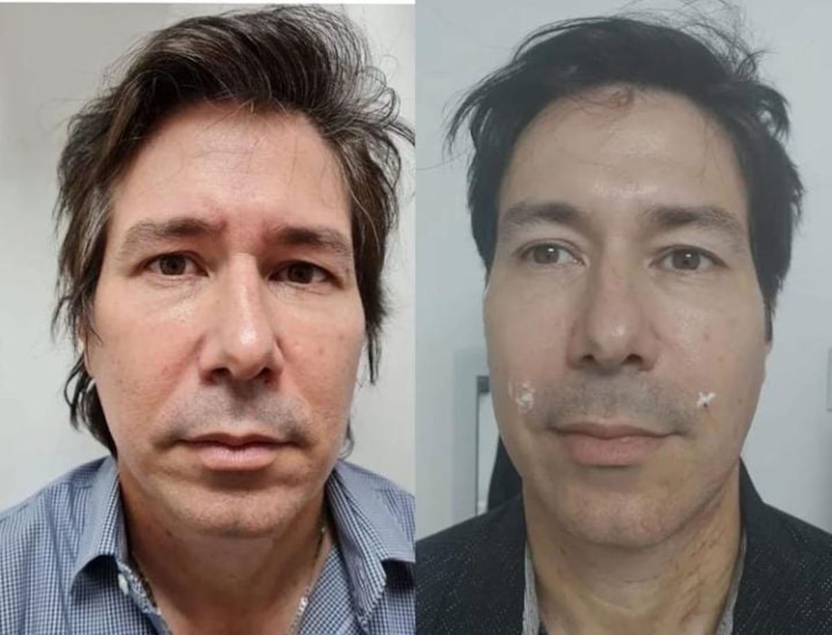 Emilio de Los Rabanes se alisa el rostro con bótox