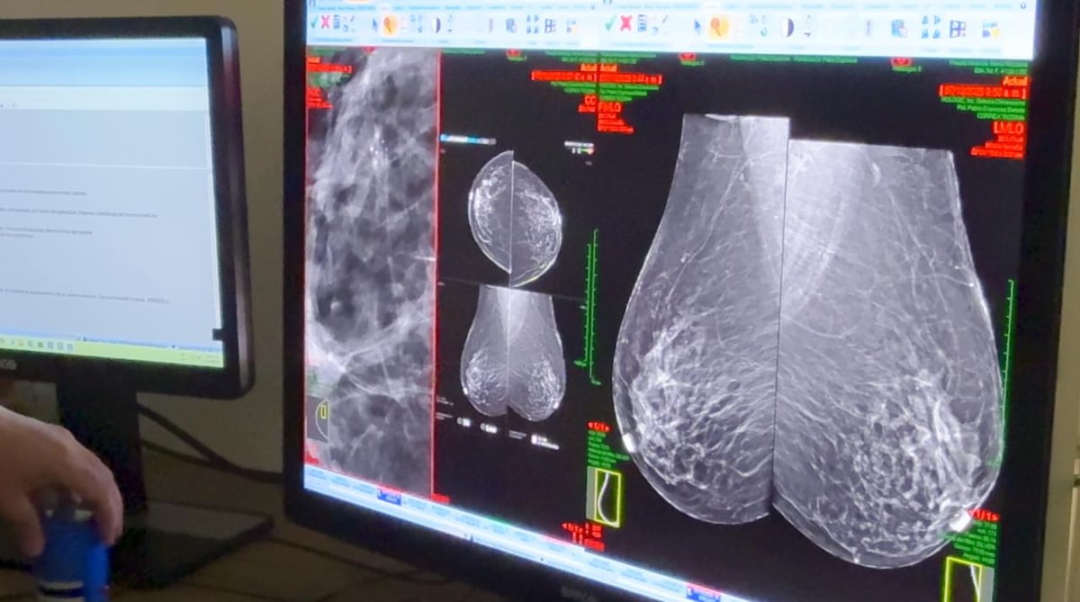 Biopsias 3D de mama: 50 mujeres atendidas en fines de semana 