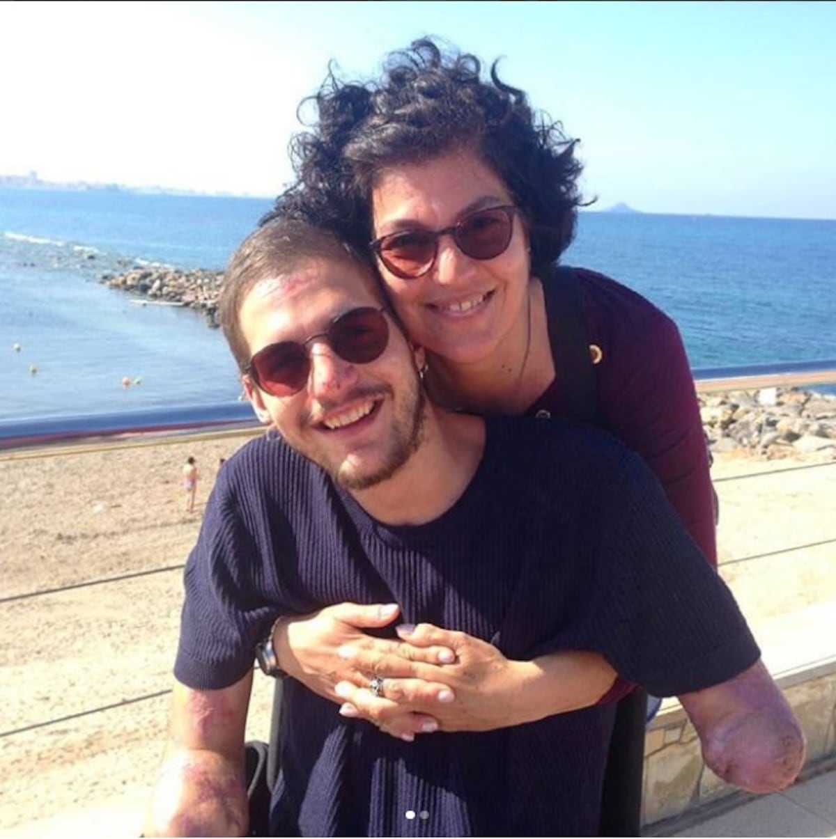 ¡QUÉ FEO! A joven italiano le amputaron pies y manos por mal diagnóstico