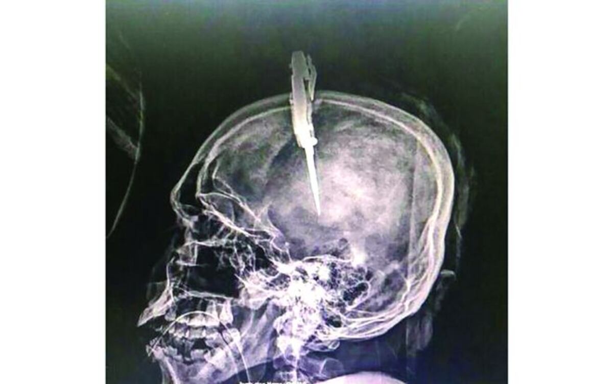 ¡NO SE RINDE! Colonense sigue batallando por su vida en el Santo Tomás 