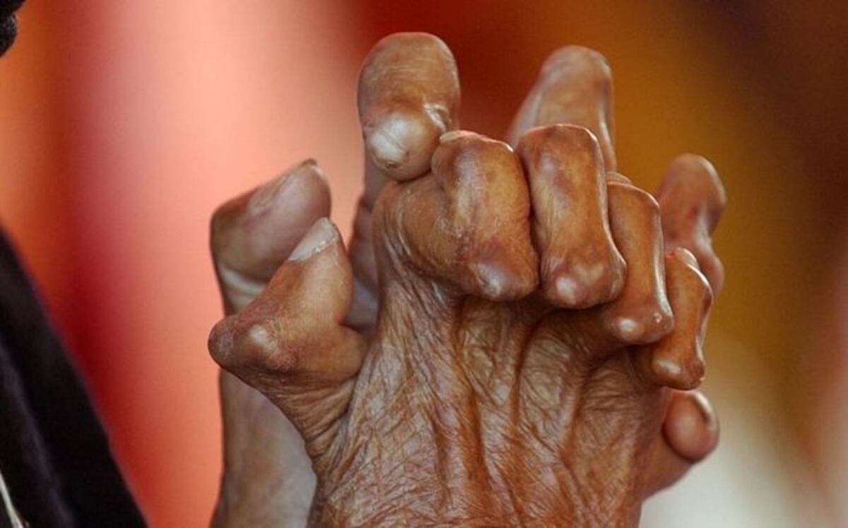 Minsa confirma casos de lepra en Darién