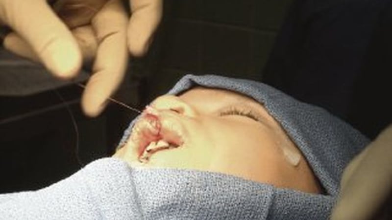 Operación Sonrisa abre centro en Curundú para pacientes en Panamá