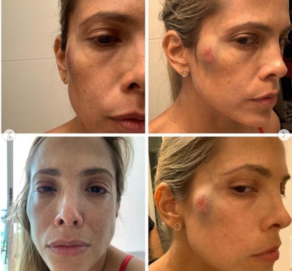Exnovia de coach panameño de salud lo denuncia por violencia de género y muestra fotos de moretones. Él reacciona