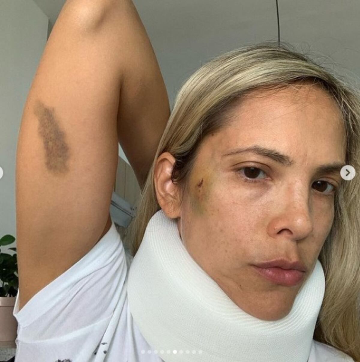 Exnovia de coach panameño de salud lo denuncia por violencia de género y muestra fotos de moretones. Él reacciona