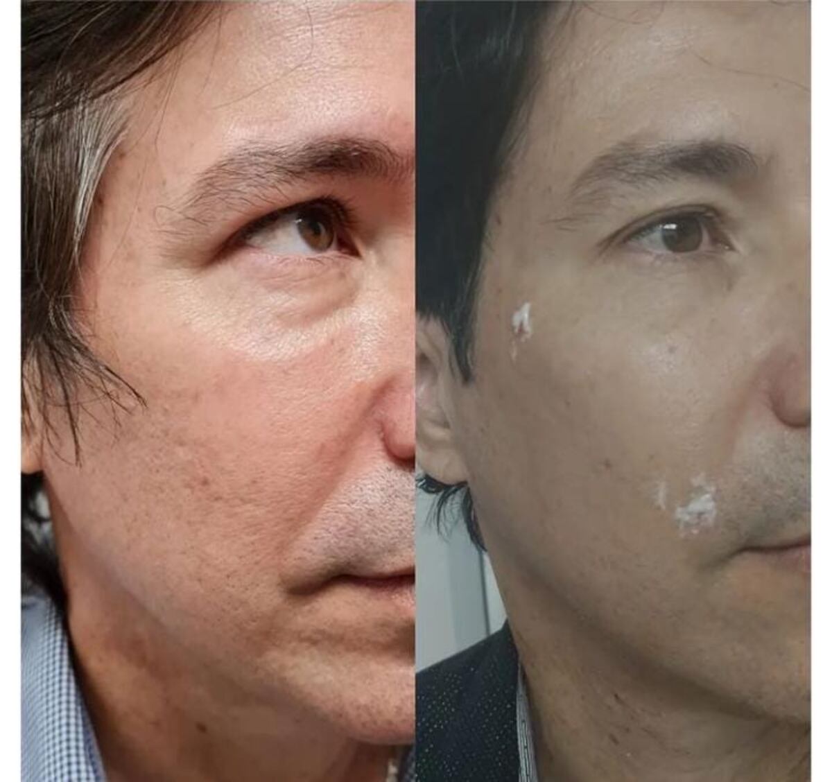 Emilio de Los Rabanes se alisa el rostro con bótox