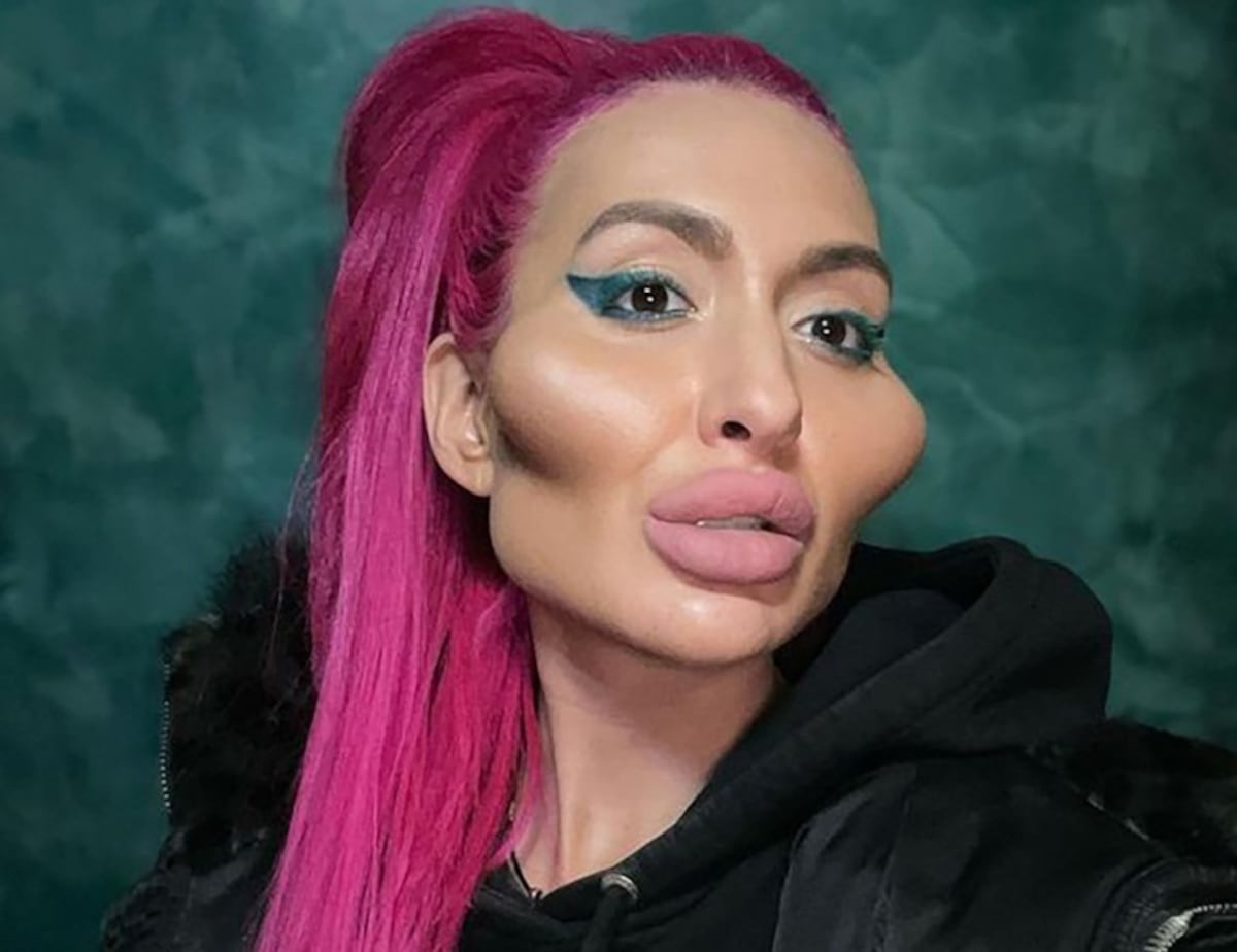 El impactante antes y después de Anastasia Pokreshchuk, la mujer con los pómulos más grandes del mundo