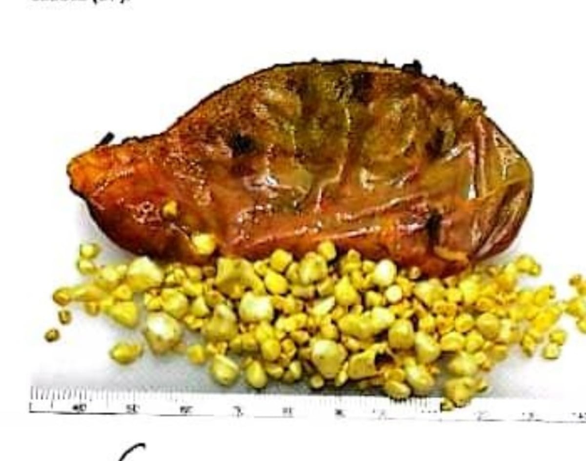 A Kelyneth Pérez le extrajeron la vesícula con cientos de piedras