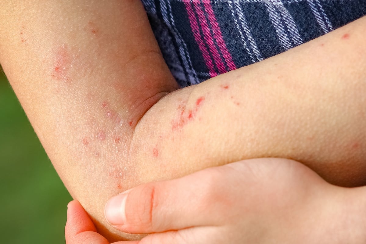 La Dermatitis Atópica: Una enfermedad que lleva a la depresión y la ansiedad