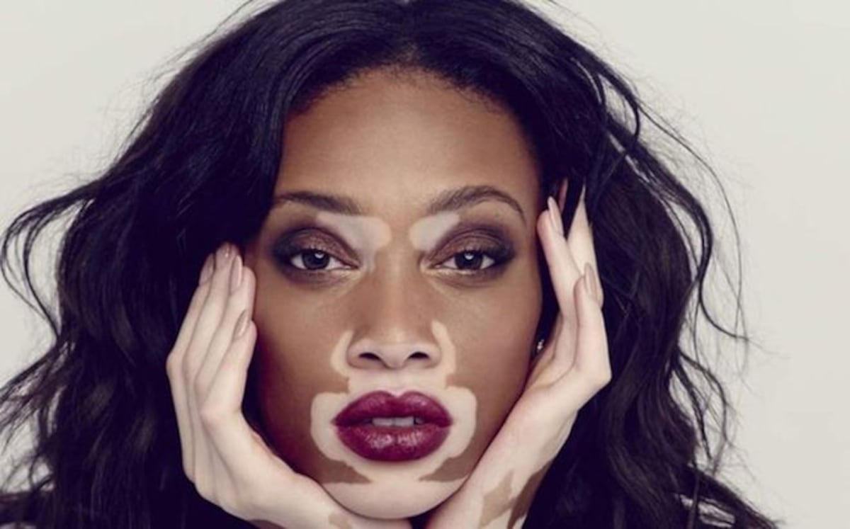 Vitiligo, una enfermedad de lento tratamiento. Conócela 