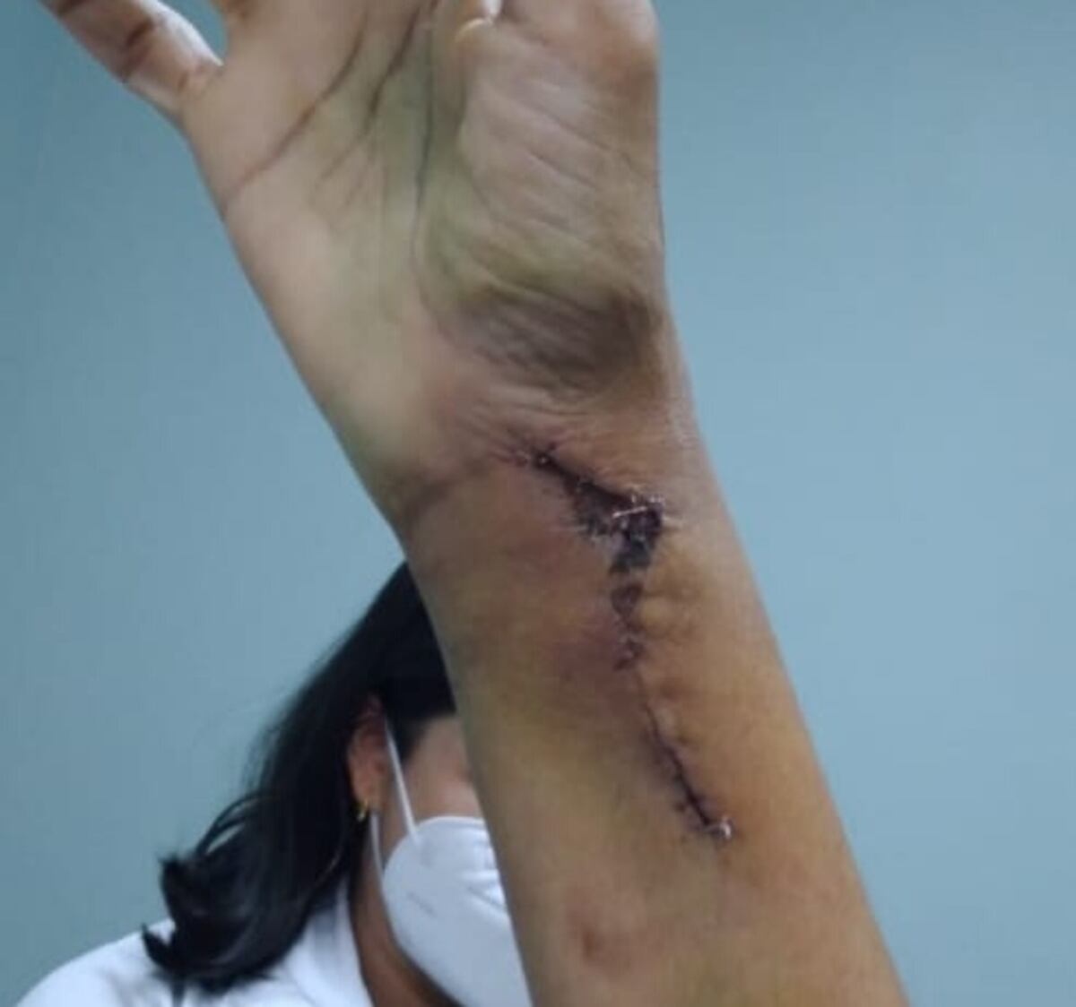 Ex primera dama está lista para las terapias de su mano derecha