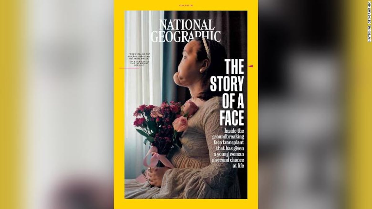 Una joven se disparó en la cara y recibe un trasplante de rostro