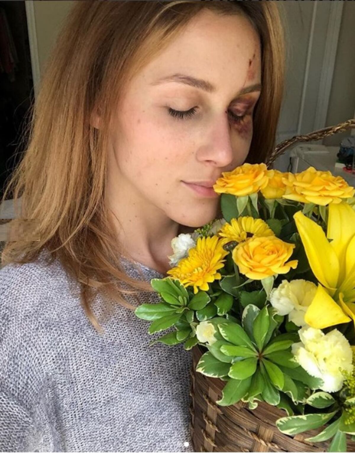 Novia acusa a campeón de motrocross de darle una brutal golpiza por celos