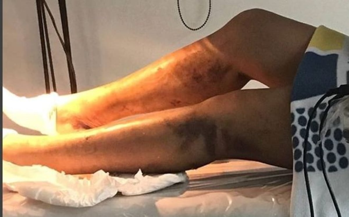 ¡AY, DIOS! Operan a Sandra Sandoval por mal procedimiento estético| VIDEOS