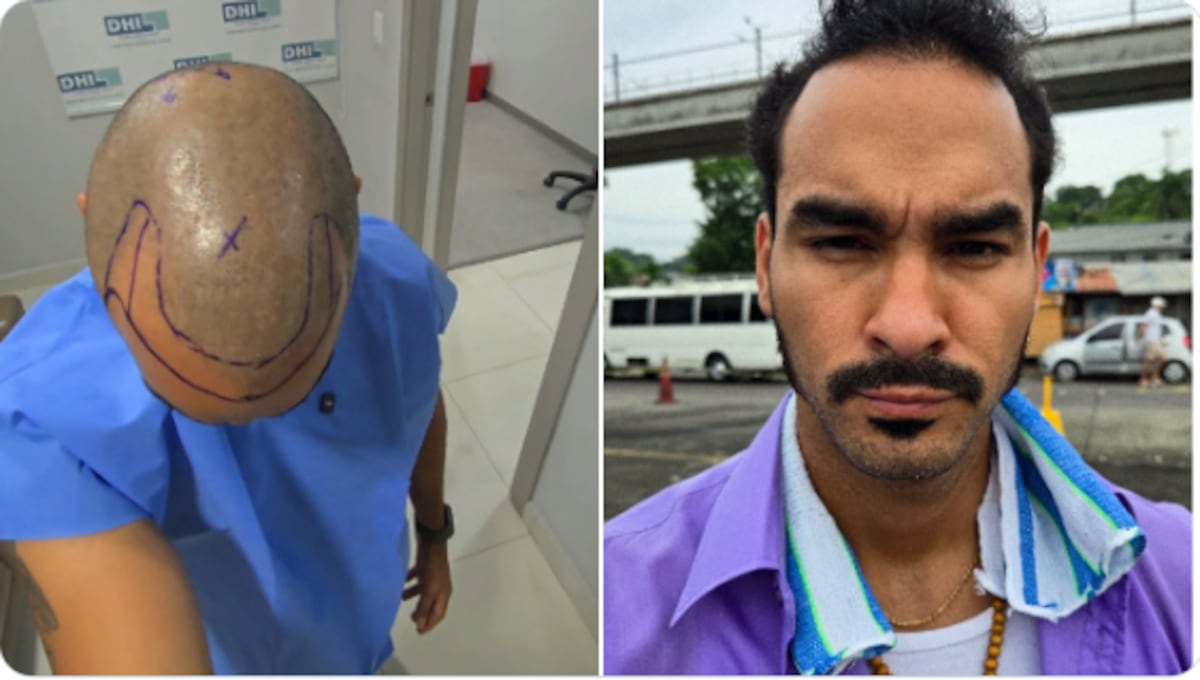 Domil Leira se la juega: se somete a implante capilar y comparte su lucha contra las inseguridades