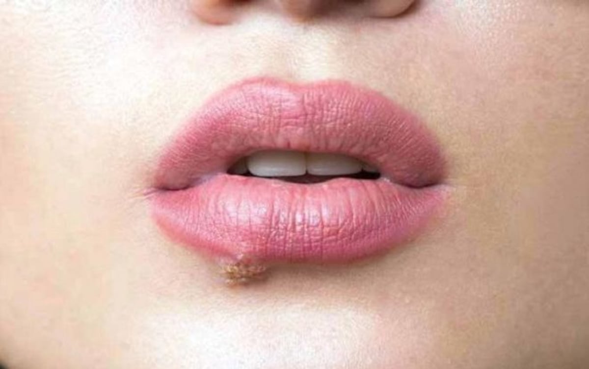 A cuidarse… Los herpes pueden causar enfermedades mentales