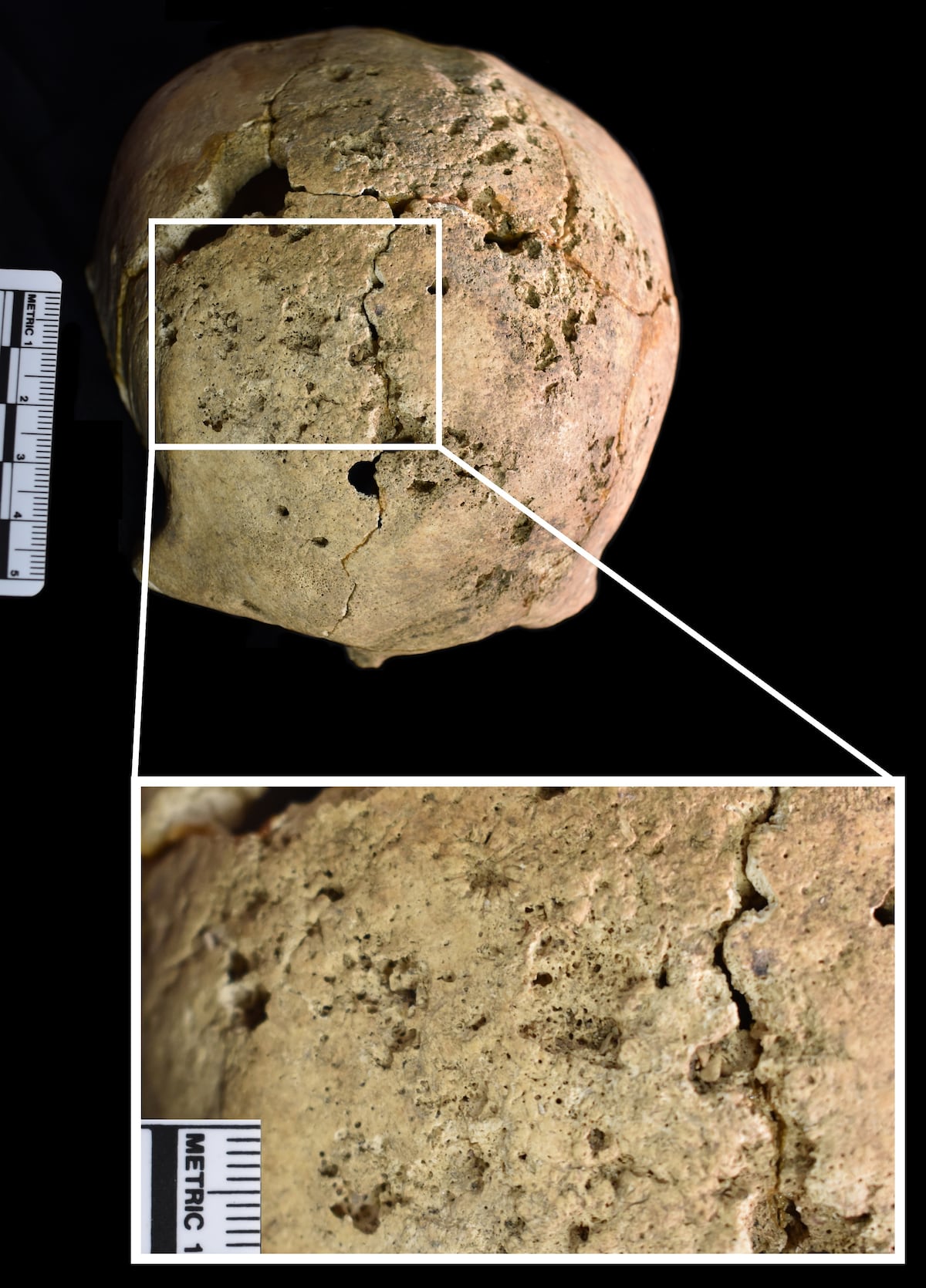 La huella del sufrimiento, en los huesos. Pobladores prehistóricos de Panamá tuvieron enfermedades venéreas y cáncer