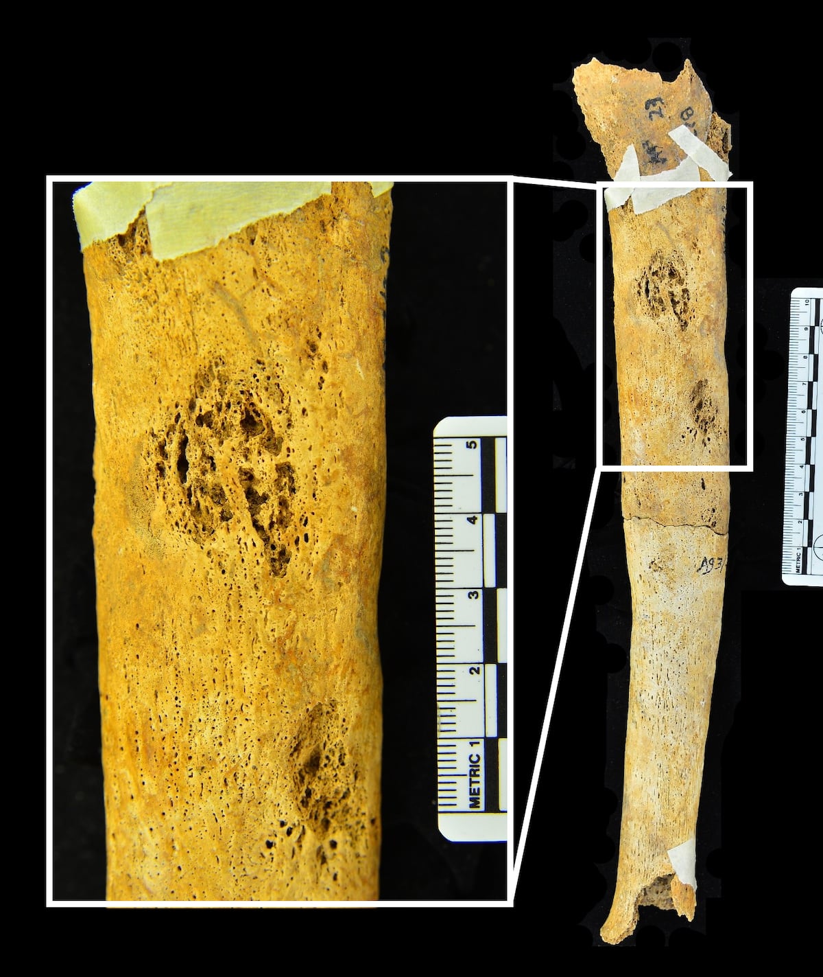 La huella del sufrimiento, en los huesos. Pobladores prehistóricos de Panamá tuvieron enfermedades venéreas y cáncer