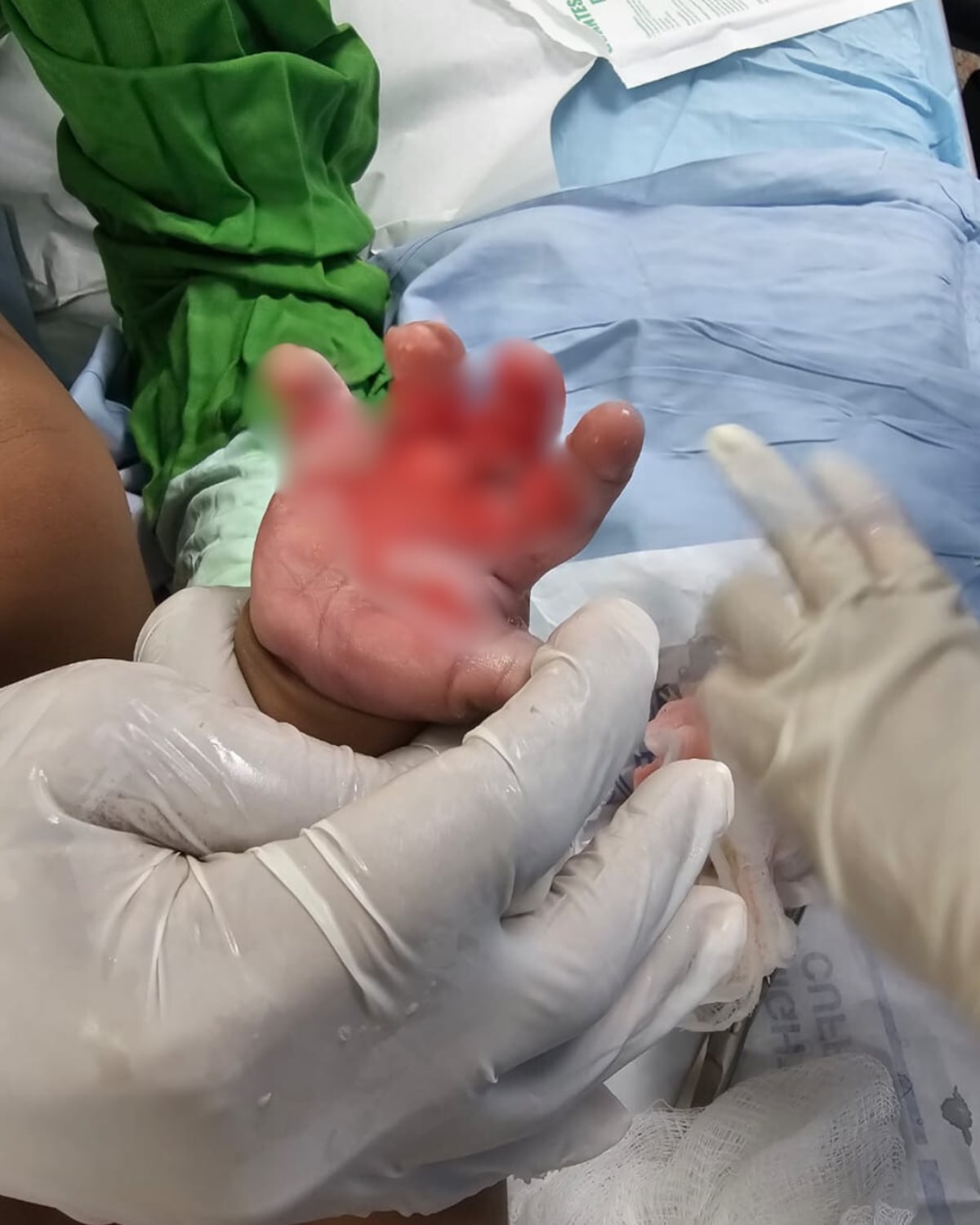 Quemaduras en niños siguen en aumento: Líquidos calientes y pirotecnia, las principales causas