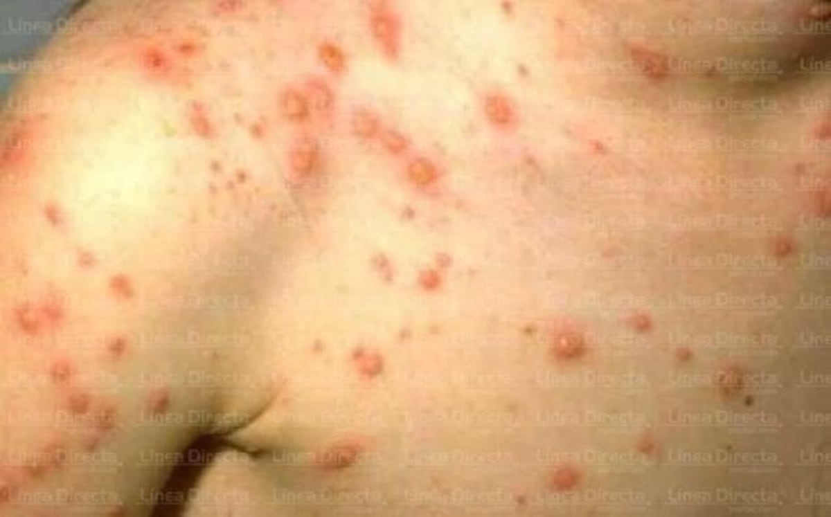 Mueren dos menores en Panamá por una enfermedad que transmiten las garrapatas