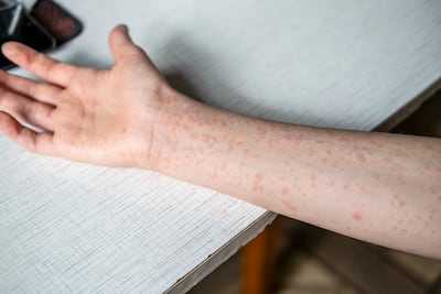 ¡Alerta sanitaria! Minsa confirma segunda persona con sarampión tras ingreso por Tocumen + VÍDEO