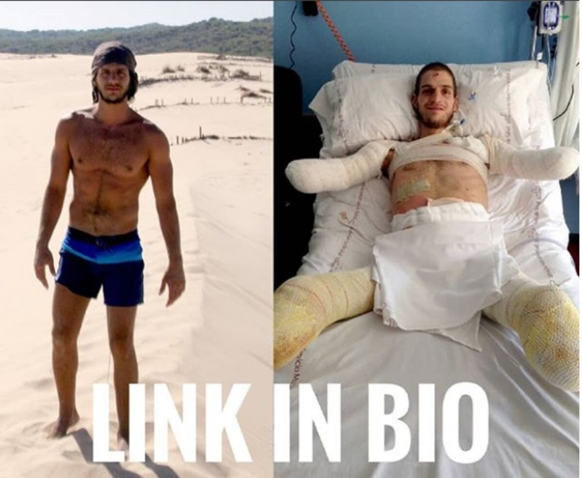 ¡QUÉ FEO! A joven italiano le amputaron pies y manos por mal diagnóstico