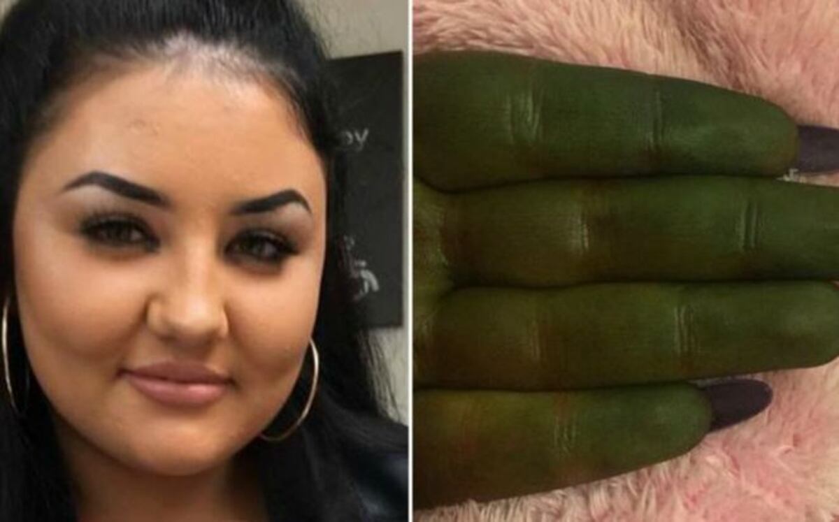 Su piel se puso verde tras usar bronceador barato ¡y ahora luce como Fiona!