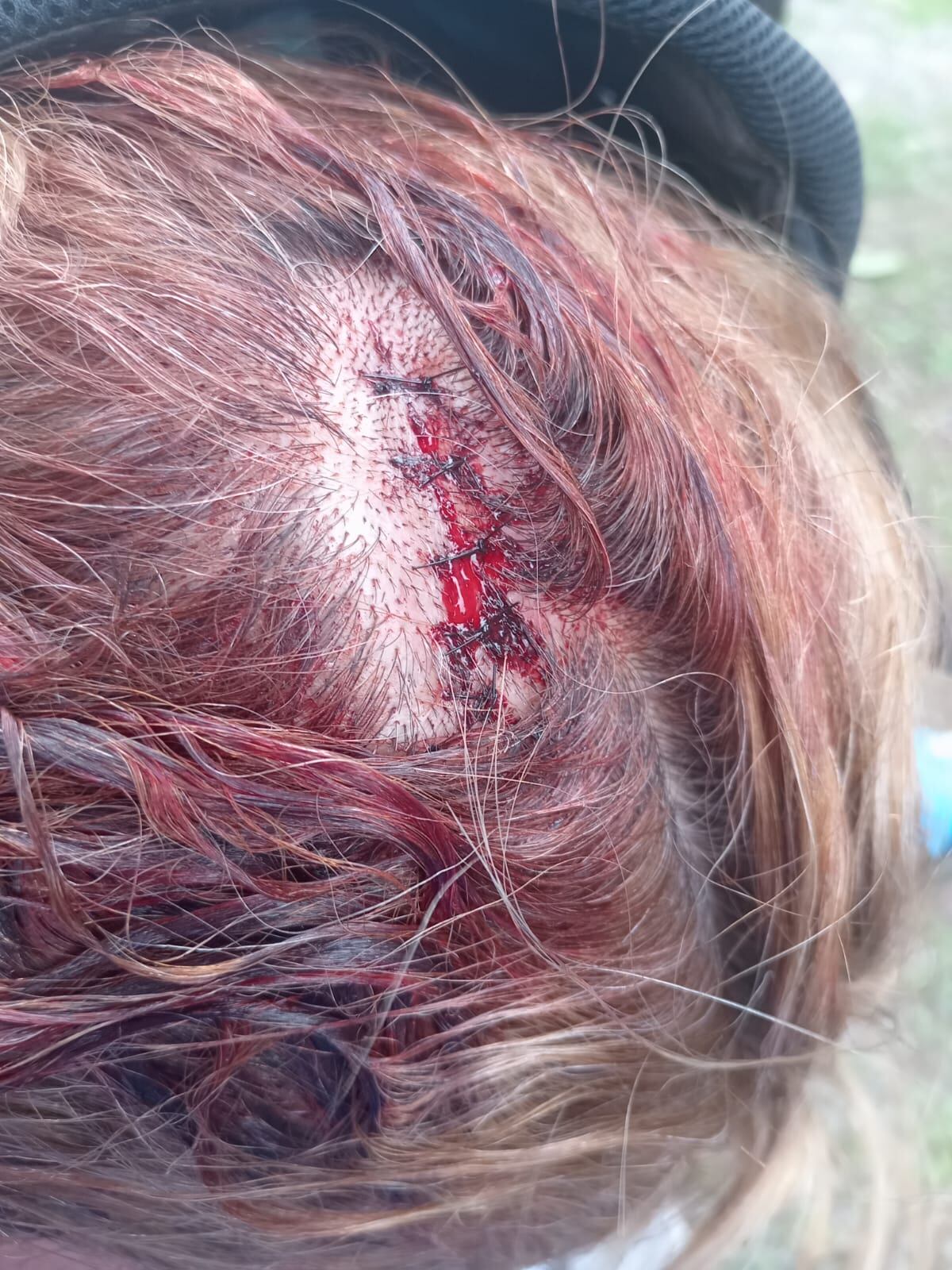 URGENTE: Atacan a machetazos y piedras a directora del INADEH en Changuinola