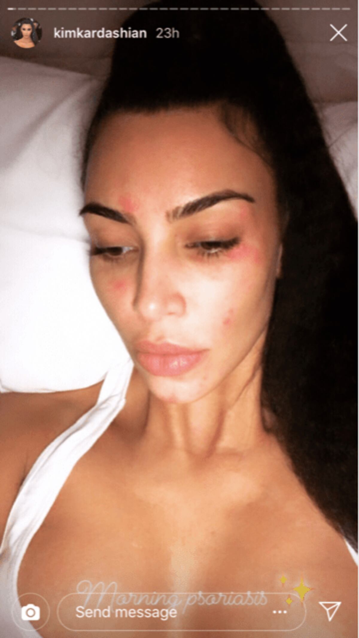 Kim Kardashian muestra las marcas de la psoriasis en su rostro