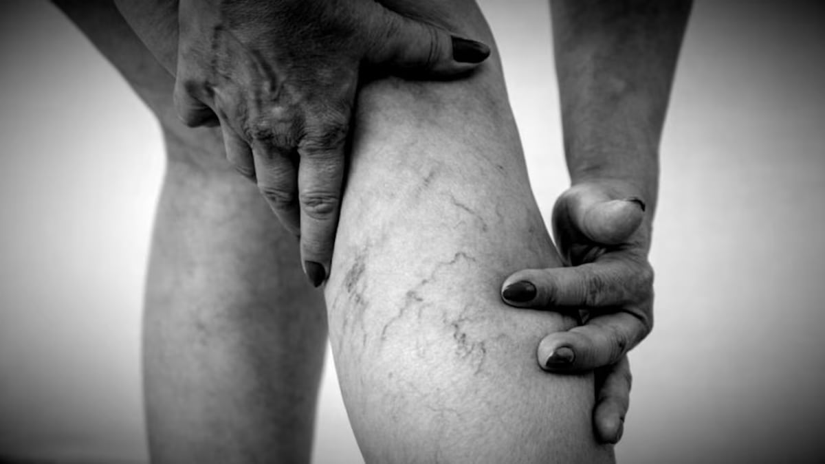 El aceite que borra las várices y alivia las piernas pesadas