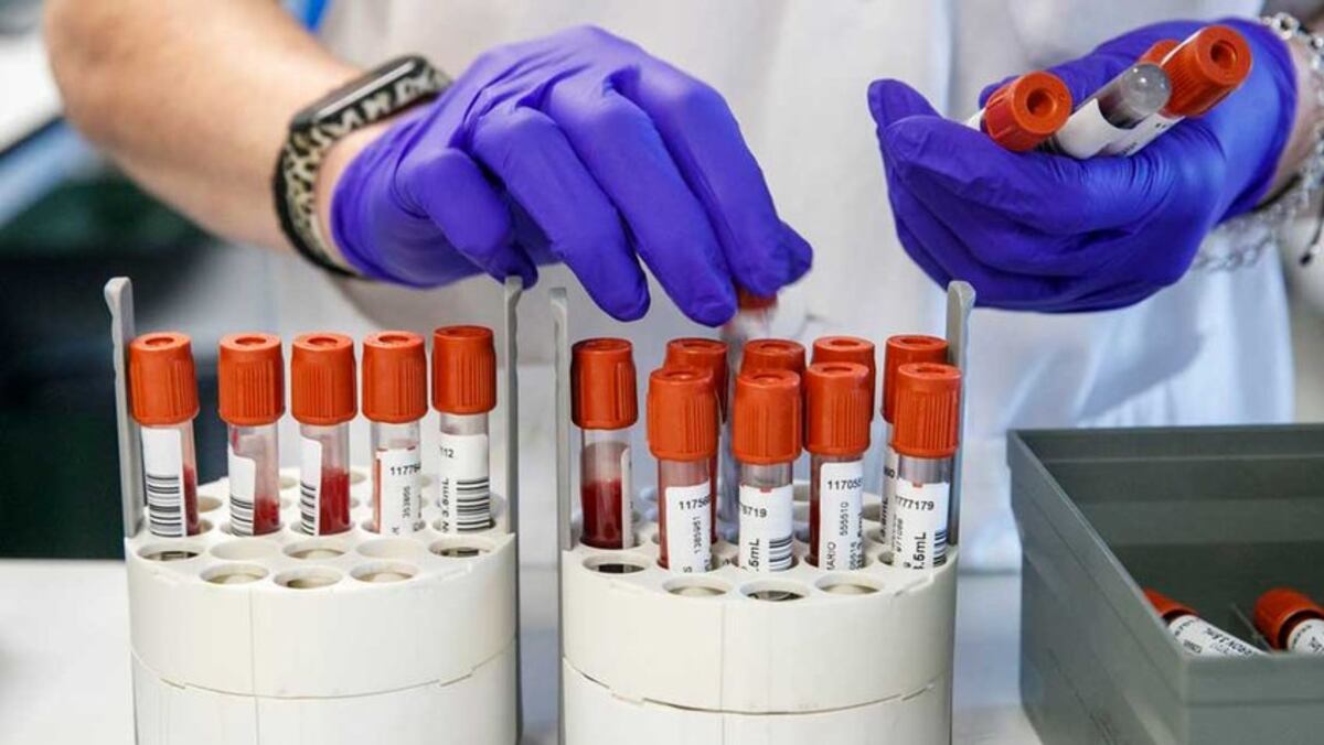 Hombre dio positivo a viruela del mono, covid-19 y VIH al mismo tiempo