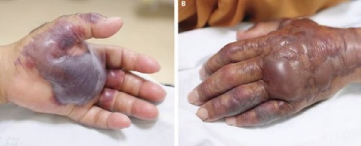 Amputan parte de brazo a hombre que comió sushi | FOTO