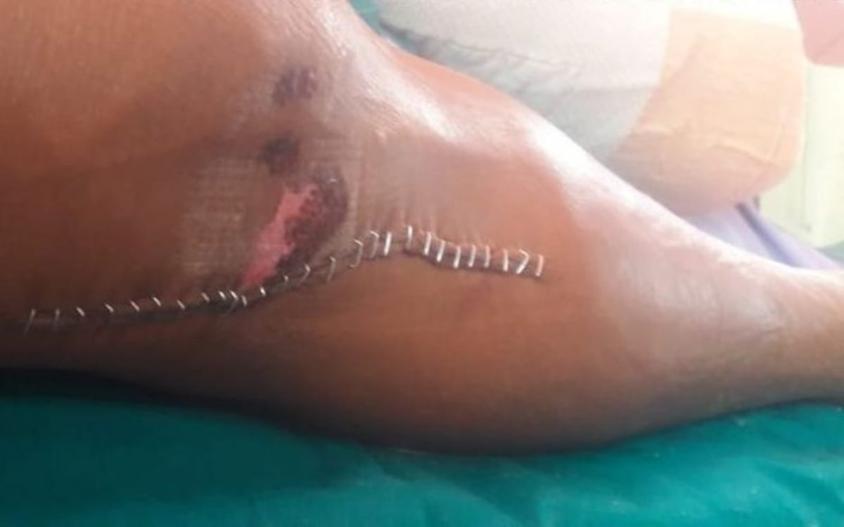 Policías confunden a señora que trabaja en la Asamblea y le rompen la pierna