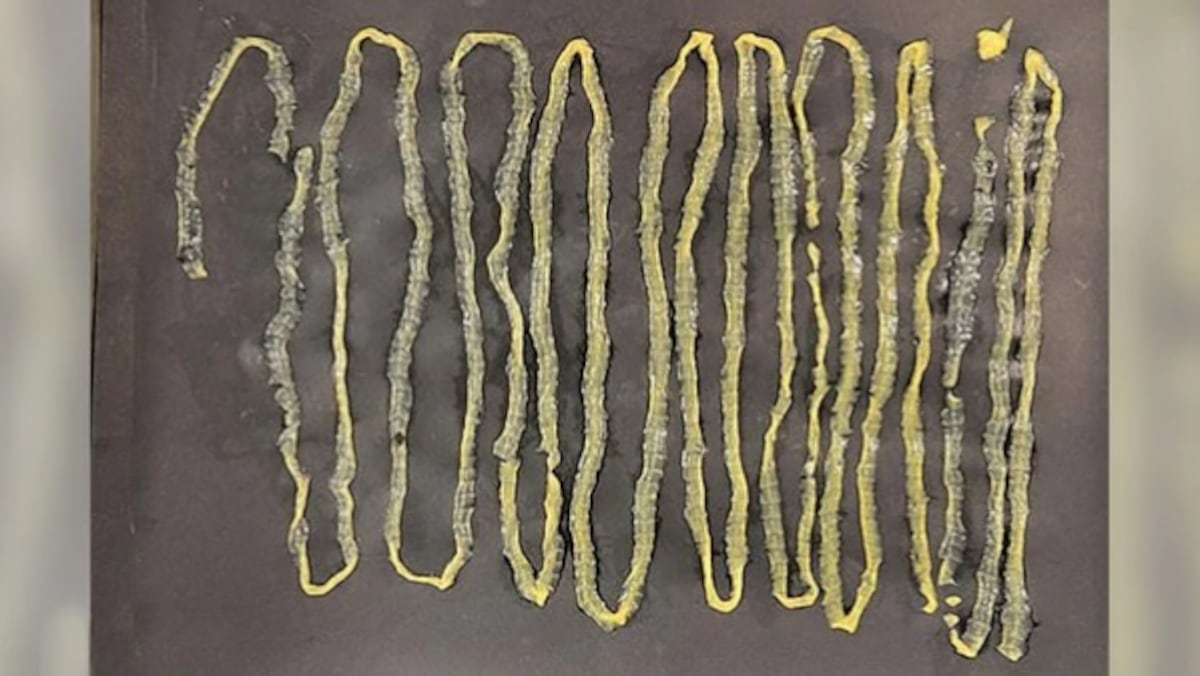 ¡QUÉ ASCO! Médicos en Singapur extraen parásito descomunal de un paciente