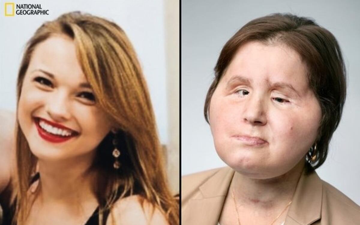 Historia del trasplante de rostro que le dio una segunda oportunidad a una joven