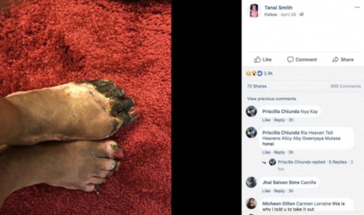 Mujer pierde los dedos del pie y casi la vida por usar un DIU que se le rompió 