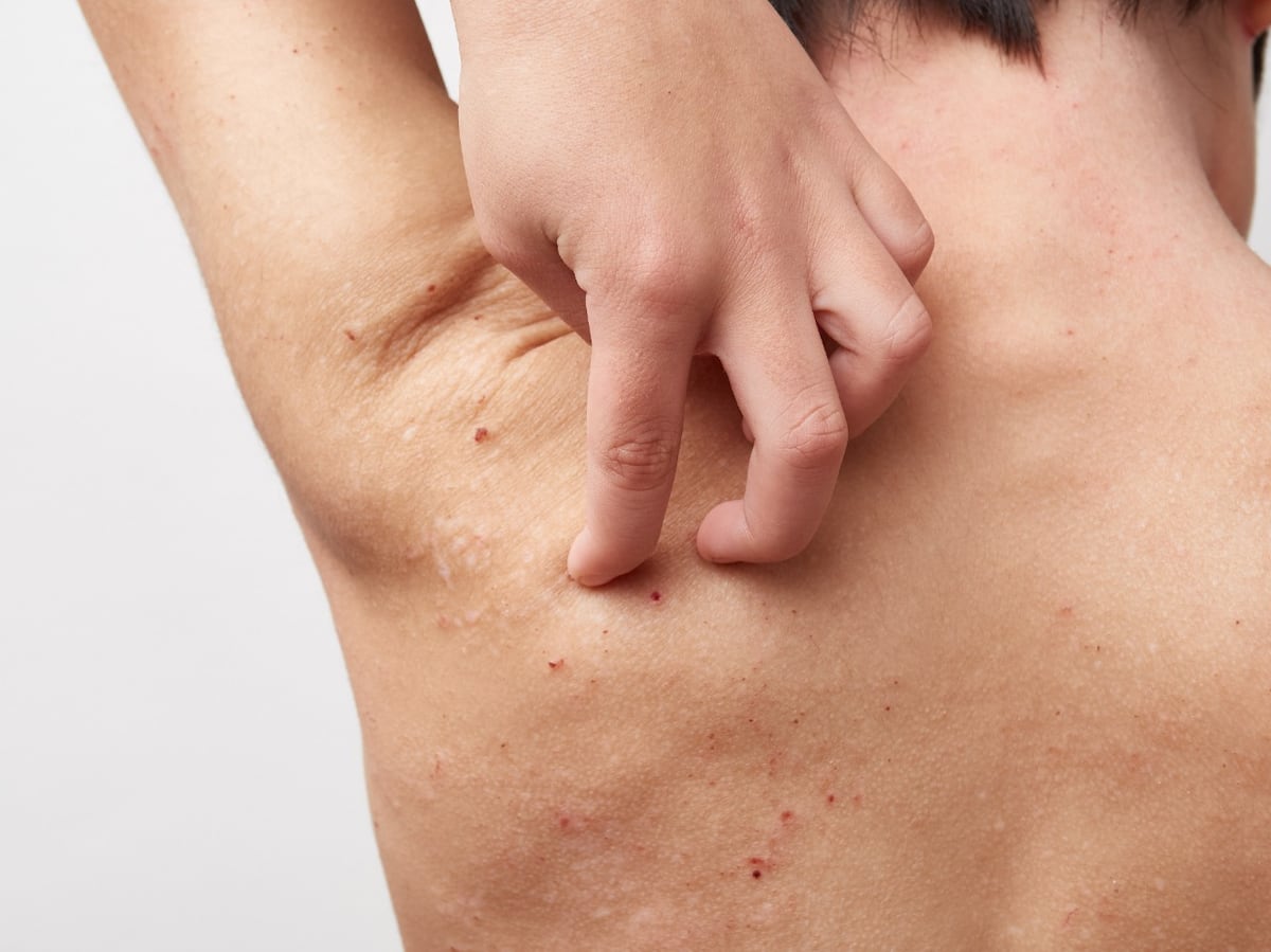 La Dermatitis Atópica: Una enfermedad que lleva a la depresión y la ansiedad