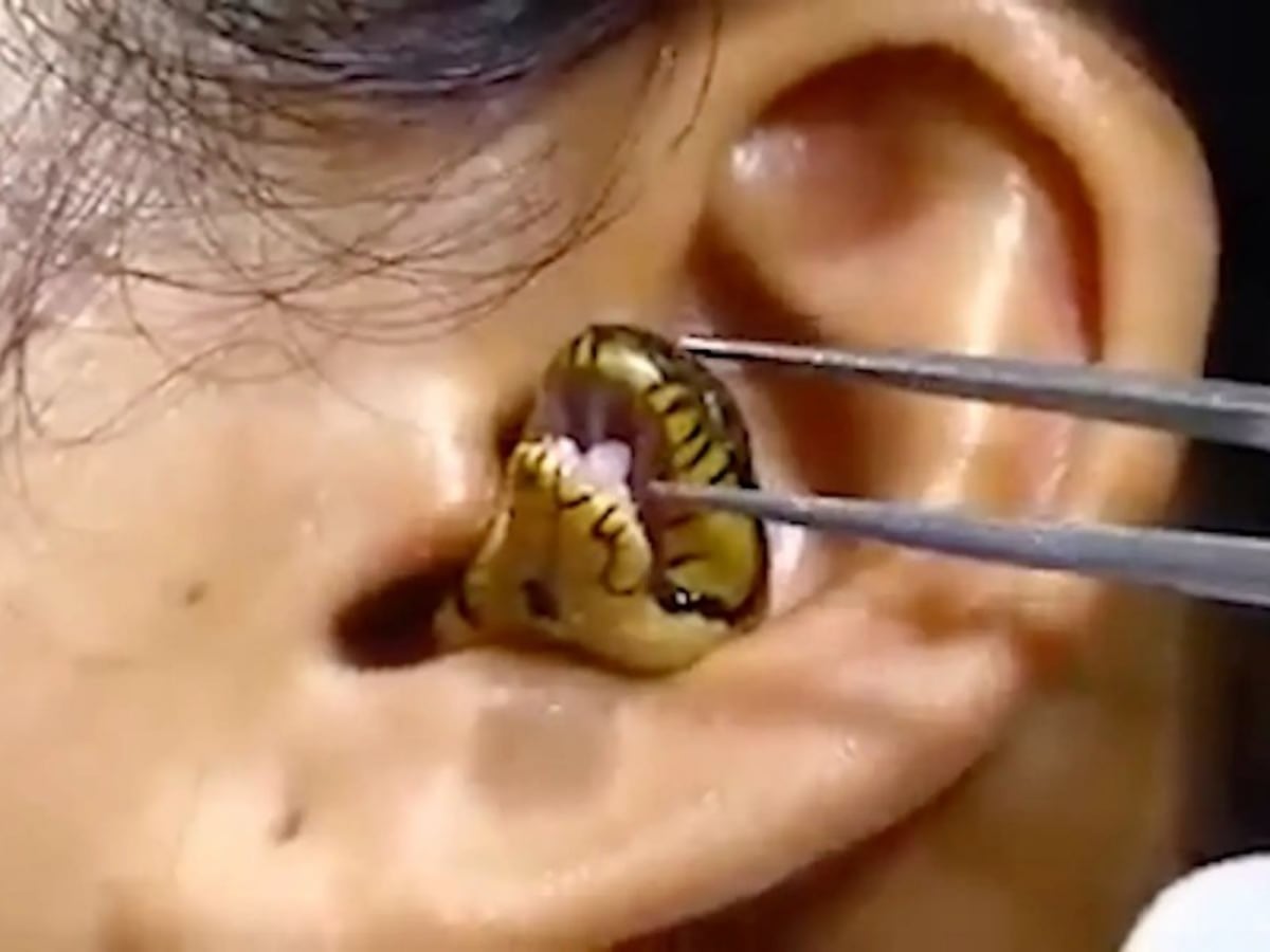 Captan a serpiente atorada en oído de mujer... y se niega a salir